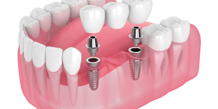What is All on 4 Dental Implants?
