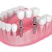 What is All on 4 Dental Implants?